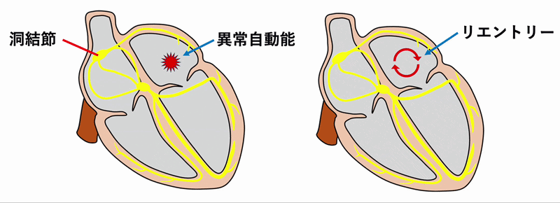 心房頻拍(atrial tachycardia)