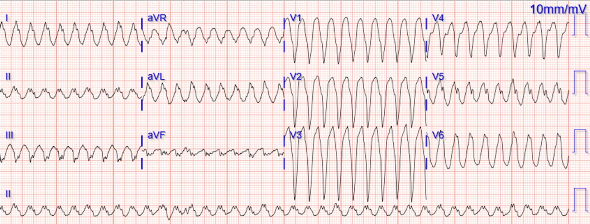 心室頻拍(Ventricular Tachycardia)