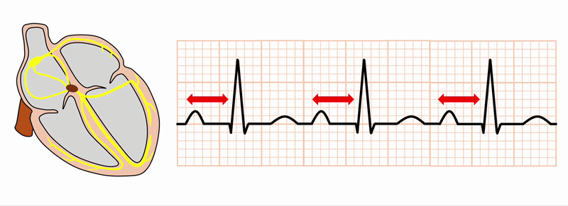 1度房室ブロック(First degree atrioventricular block)