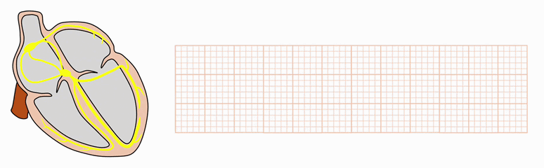 洞頻脈(Sinus tachycardia)