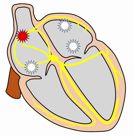 移動性ペースメーカ(wandering atrial pacemaker)