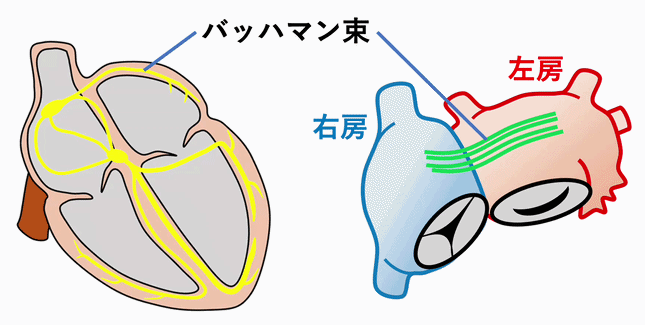 心房間ブロック(Interatrial Block：IAB)