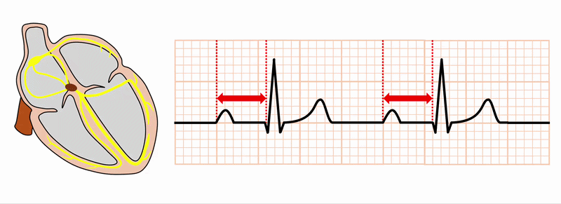1度房室ブロック(First degree atrioventricular block)
1度房室ブロックとは、心房から心室へ興奮が伝わる際に伝導が遅延し、心電図上のPQ間隔が通常より延長している状態をいいます