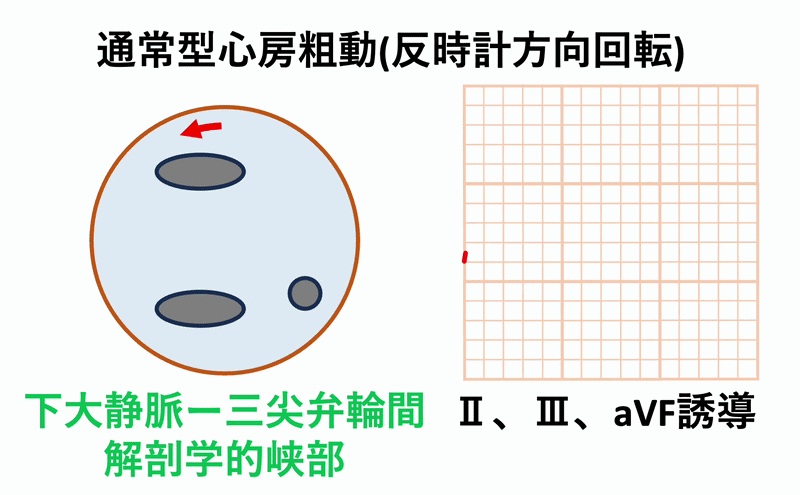 心房粗動(Atrial flutter)