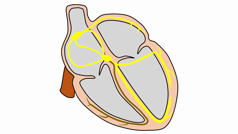 右脚ブロック(right bundle branch block:RBBB)