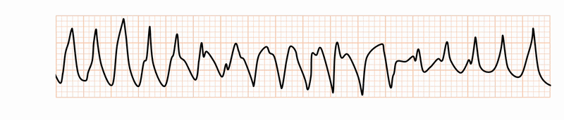 torsade de pointes(TdP)