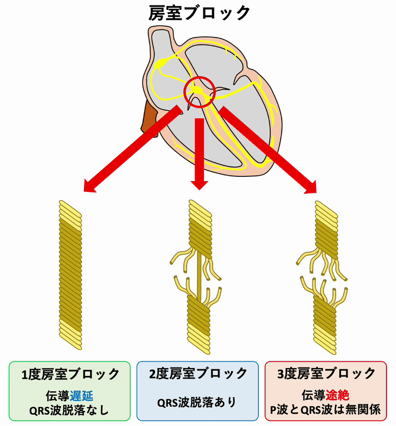 1度房室ブロック(First degree atrioventricular block)