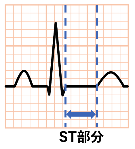 ST部分(ST segment)