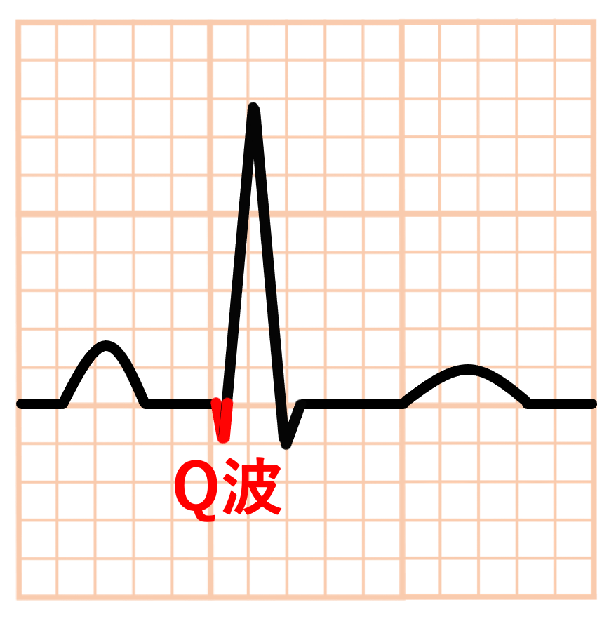 Q波(Q wave)