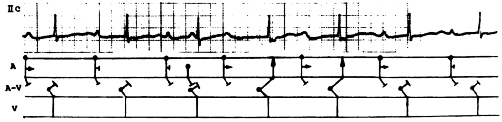 完全房室ブロック(complete atrioventricular block)