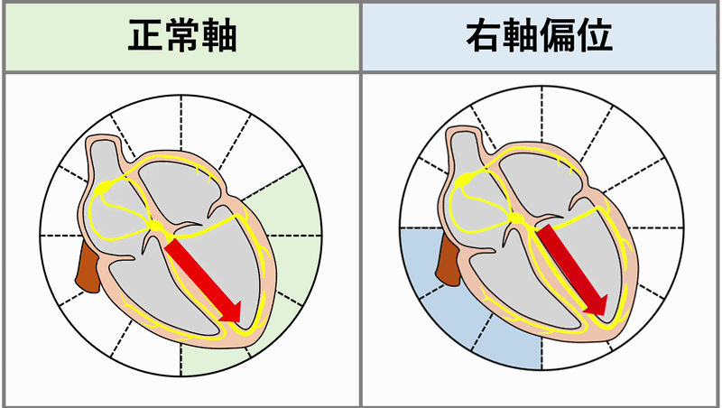 右軸偏位(right axis deviation)