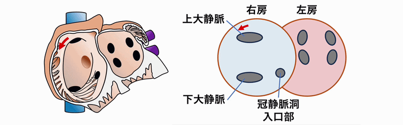 心房粗動(Atrial flutter)