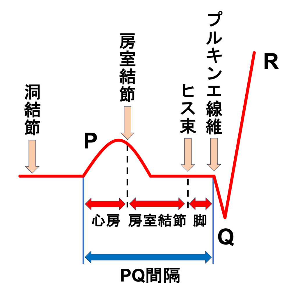 1度房室ブロック(First degree atrioventricular block)