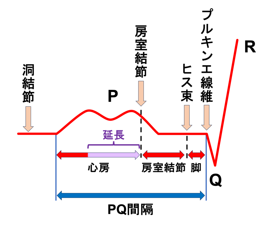 1度房室ブロック(First degree atrioventricular block)
