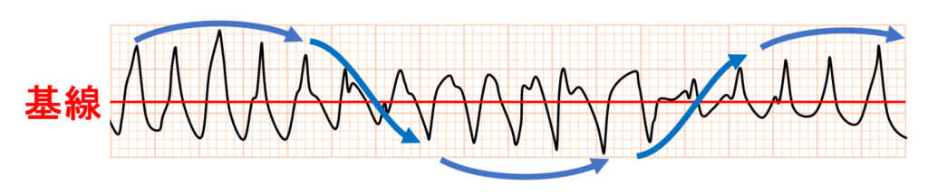 torsade de pointes(TdP)