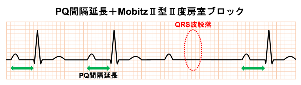 1度房室ブロック(First degree atrioventricular block)