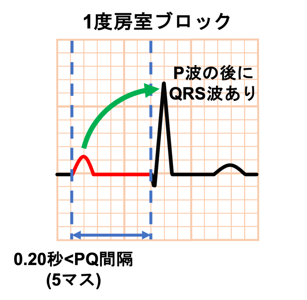 1度房室ブロック(First degree atrioventricular block)