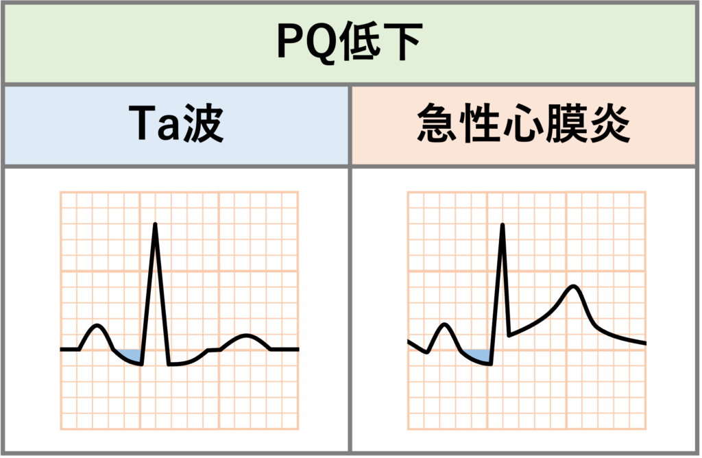 PQ部分(PQ segment)