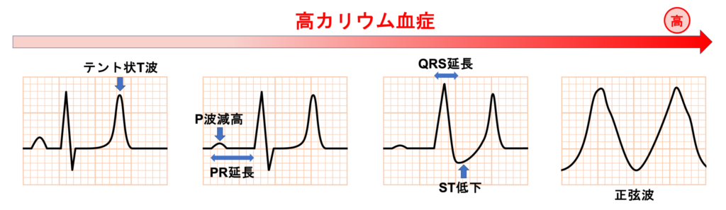 高カリウム血症(Hyperkalemia)