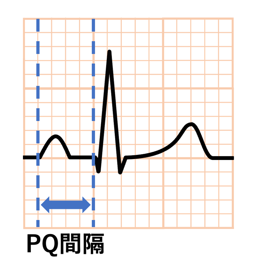 PQ間隔(PQ interval)
P波の始まりからQ波の始まりまでをPQ間隔と言います。Q波が存在しないこともあるので、その場合はR波の始まりまでを基準にしてPR間隔(PR interval)とも呼ばれます。