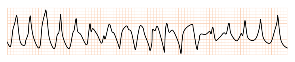 torsade de pointes(TdP)