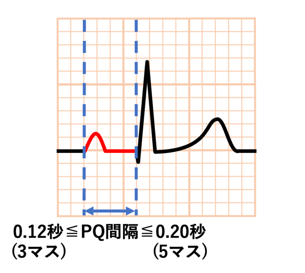 PQ間隔(PQ interval)
正常値は0.12秒≦PQ間隔≦0.20秒です。通常は1マスが0.04秒なので、PQ間隔が3マスから5マスの間であれば正常範囲内と言えます。
