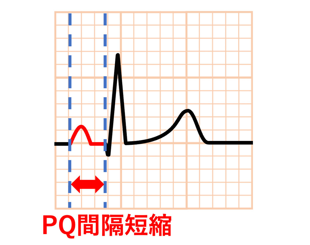 PQ間隔(PQ interval)