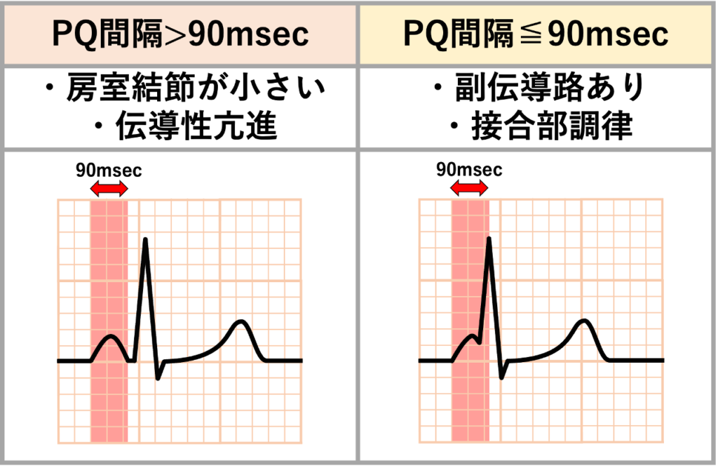 PQ間隔(PQ interval)
PQ間隔短縮を見た時に、PQ間隔が90msec以下の場合は副伝導路によるショートカットや接合部調律(等頻度房室解離)を考えます。