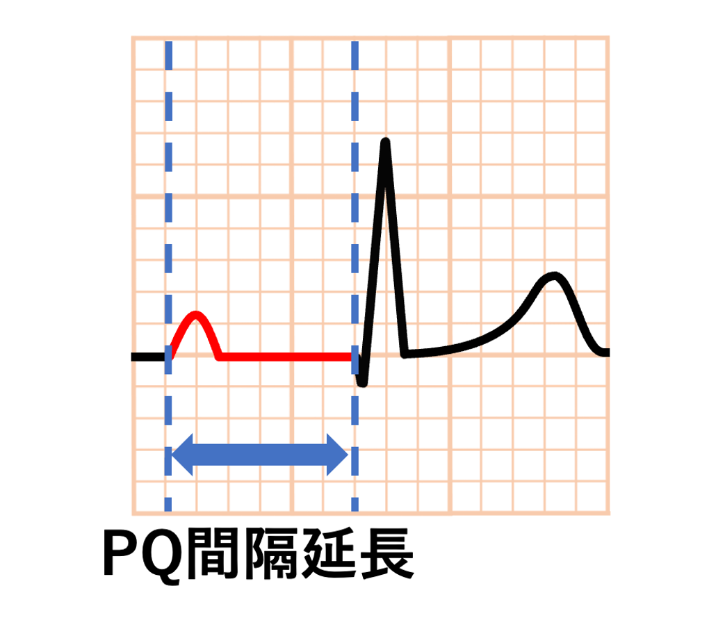 PQ間隔(PQ interval)
PQ間隔>0.20秒でPQ間隔延長になります。PQ間隔が延長する原因としては1度房室ブロックやジギタリス効果があります。