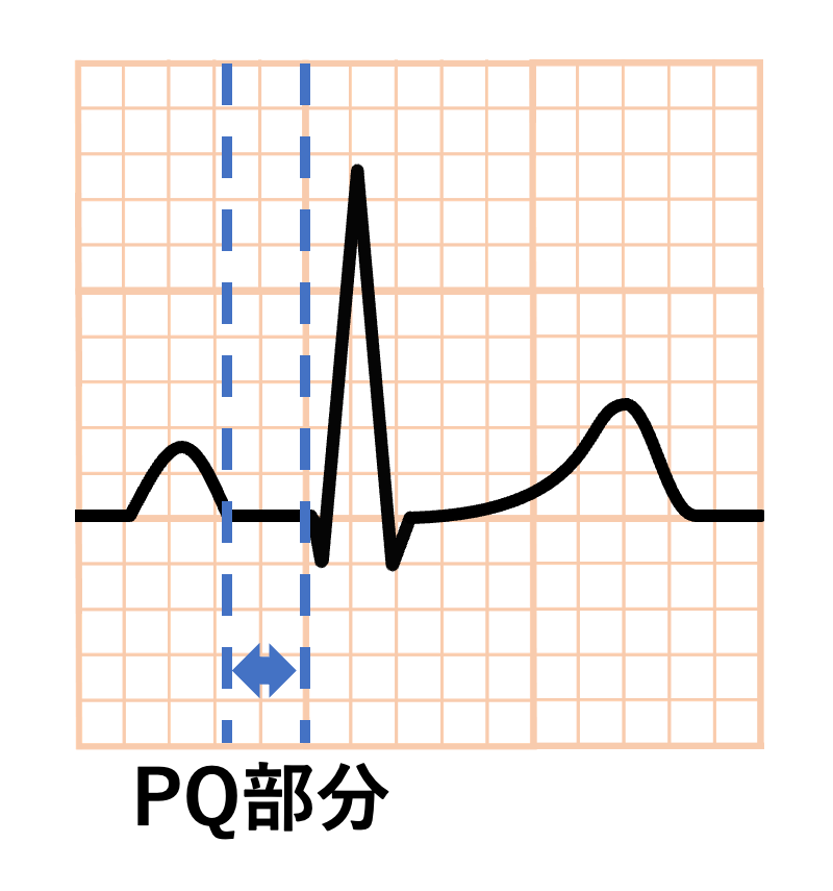 PQ部分(PQ segment)
P波の終わりからQ波の始まりまでをPQ部分と言います。Q波がない場合はPR部分(PR segment)とも言います。PQ間隔(PQ segment)とPQ部分(PQ interval)は違う場所を計測しています。