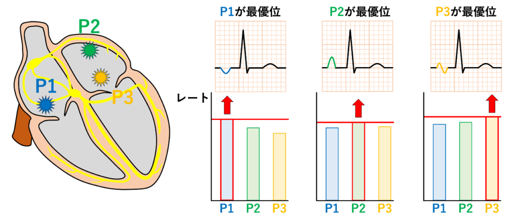 移動性ペースメーカ(wandering atrial pacemaker)
移動性ペースメーカはペースメーカの優位性が一定しないので特定の1種類のP波が持続しない状態です。3つ以上の心房ペースメーカ部位の自動能が競合することで優位となるペースメーカが移動します。複数のペースメーカ部位の興奮頻度は同程度で大きく変わらないため心拍数は大きく変化せず、移動性ペースメーカの心拍数は100回/分未満とされています。