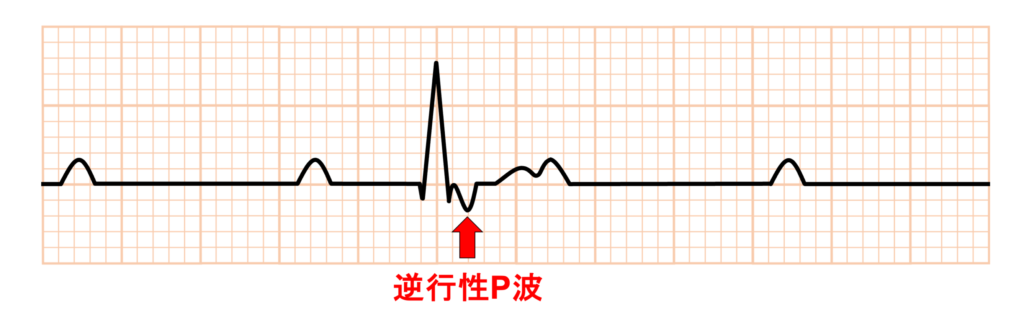 完全房室ブロック(complete atrioventricular block)
完全房室ブロックでは心房から心室への順行性伝導(房室伝導)はないにもかかわらず、心室から心房への室房伝導が可能な場合があり、QRS波の直後に逆行性P波が出現することがあります。