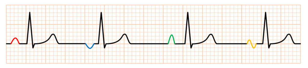 多源性心房調律(multifocal atrial rhythm)
多源性心房調律では心房の興奮の焦点が３ヶ所以上あり(多源性)、それぞれからランダムに興奮が出現します。心電図所見としては同一誘導で3種類以上のP波、PR間隔が異なる、心拍数が100回/分未満、加えてP波形態の変化がランダム(not gradual)になります。心拍数が100回/分以上になると多源性心房頻拍と呼ばれます