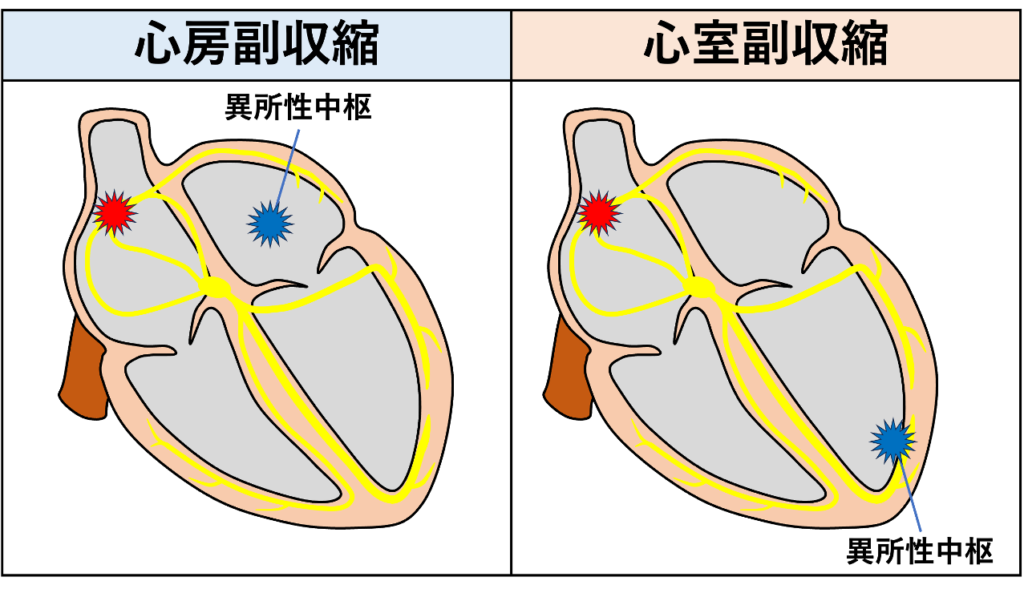 副収縮(Parasystole)
副収縮とは、洞調律(基本調律)とは独立して興奮を繰り返す異所性中枢が存在し、心房または心室が洞結節と異所性中枢の2つの興奮源によって支配されている状態です。異所性中枢が心房に存在するものを心房副収縮、心室に存在するものを心室副収縮と呼びます。副収縮の多くは心室性であり、異所性中枢は心室内に存在します。