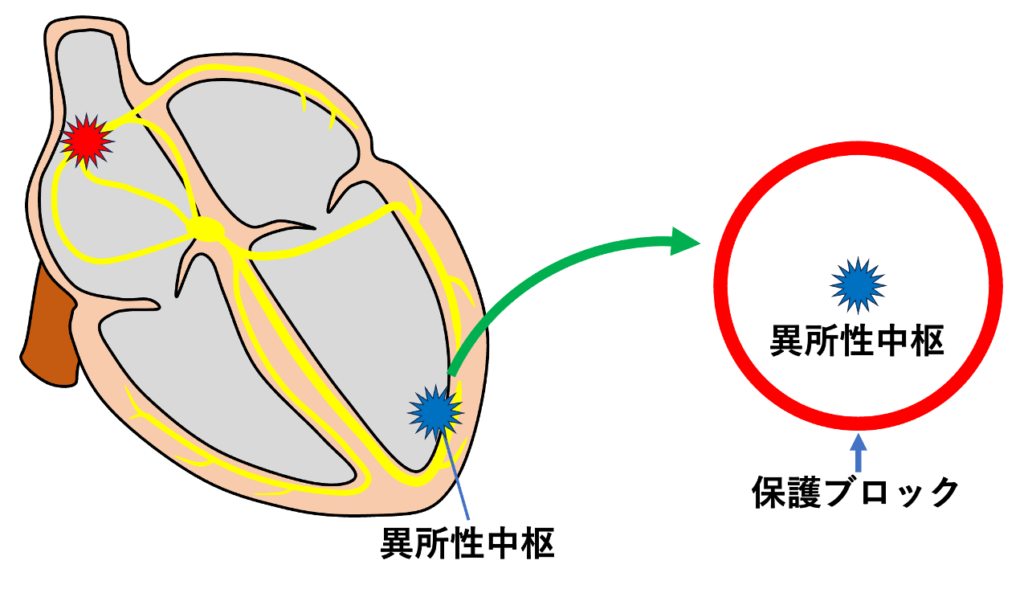 副収縮(Parasystole)
副収縮が成立するためには、保護ブロック(protective block)の存在が必要です。保護ブロックとは、洞調律など周囲の心筋から伝わってくる興奮が副収縮中枢へ侵入するのを遮断し、副収縮中枢が外部からの興奮によって脱分極されないように保護するメカニズムです。