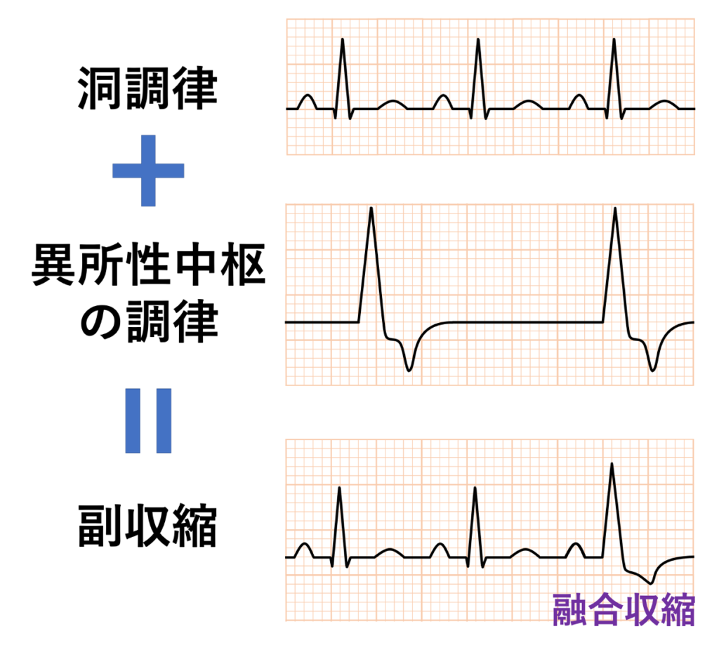 副収縮(Parasystole)
副収縮が洞調律の興奮と重なった場合は融合収縮(fusion beat)となりQRS波形が変わります。連結期が一定しないこと、副収縮の間隔が基本となる副収縮の周期の整数倍となることと合わせて副収縮の古典的3徴と呼ばれます。ただし、融合収縮は必ず出現するわけではありません。