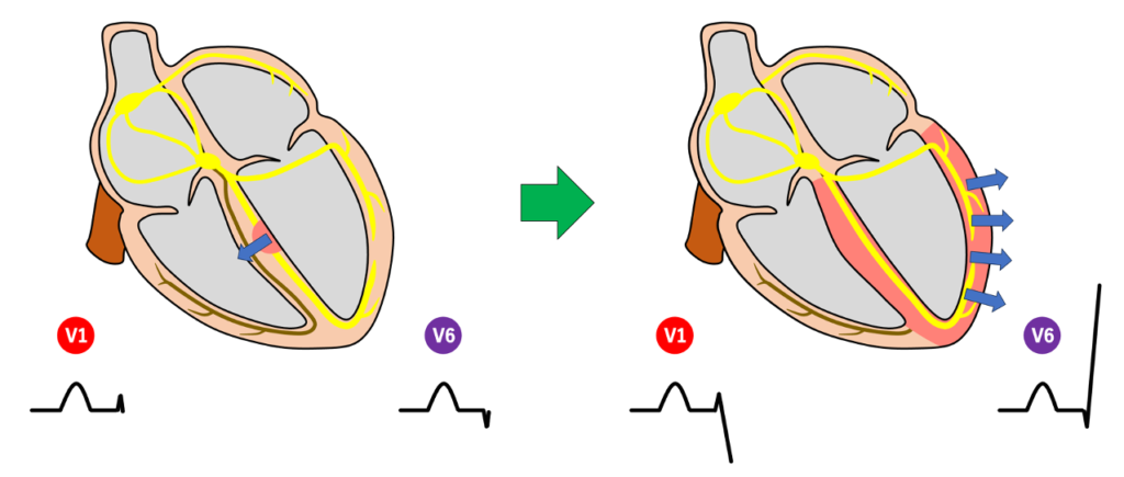 右脚ブロック(right bundle branch block:RBBB)