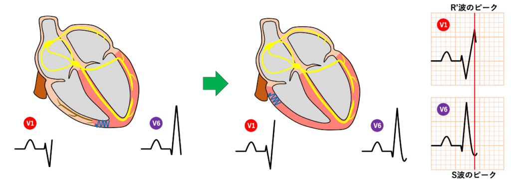 右脚ブロック(right bundle branch block:RBBB)