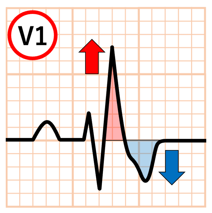 右脚ブロック(right bundle branch block:RBBB)
心室の脱分極の順序が変化すると、それに伴って再分極(ST部分・T波)の方向も変化します。これを二次性ST-T変化と呼びます。右脚ブロックでは右室の脱分極の順番が変化しているため、右室の興奮を反映するV1誘導でQRS波の終末が陽性となりますが、ST部分・T波はこれと反対方向を向くため、ST低下・陰性T波がみられます。