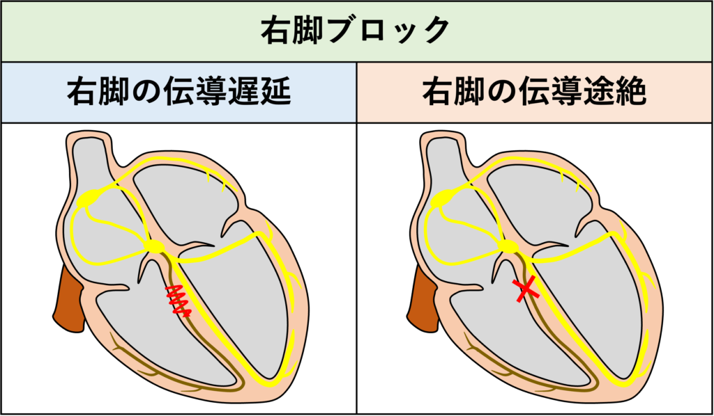 右脚ブロック(right bundle branch block:RBBB)