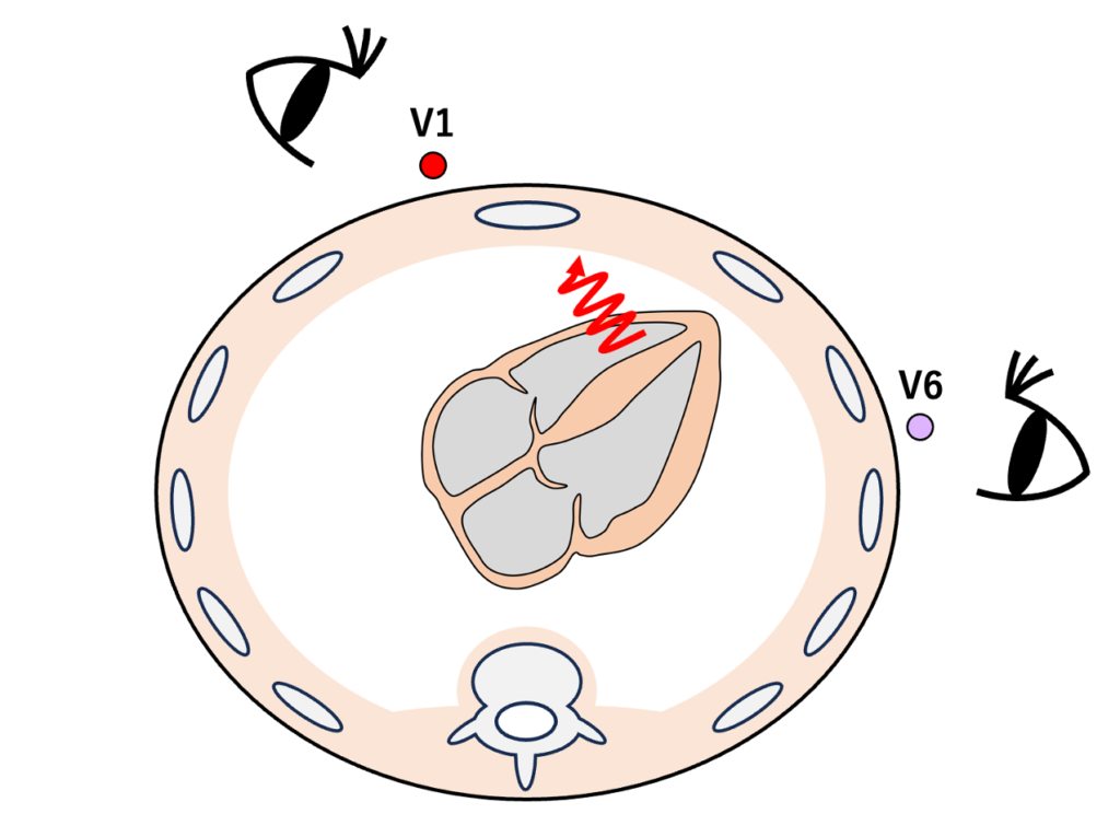 右脚ブロック(right bundle branch block:RBBB)