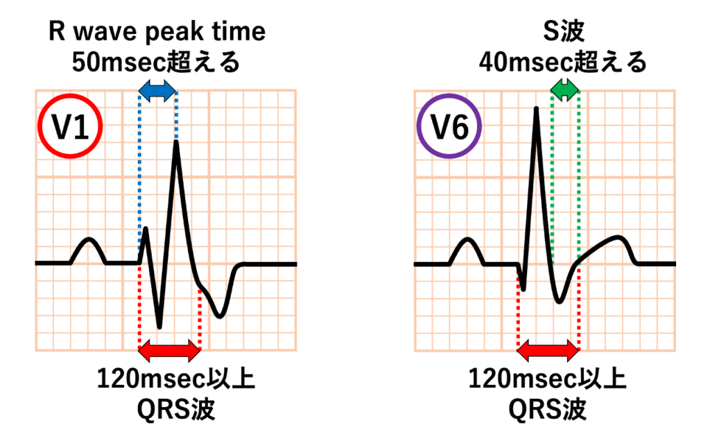 右脚ブロック(right bundle branch block:RBBB)