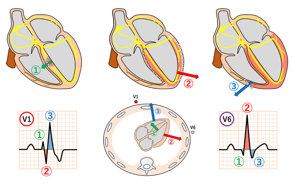 右脚ブロック(right bundle branch block:RBBB)