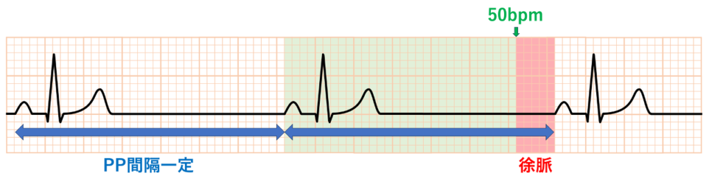 洞徐脈(sinus bradycardia)
洞結節からの興奮であるため、波形自体に変化はなく、心拍が遅いだけなので洞調律の時と同じ波形をしています。心拍数は50/分未満であり、PP間隔、RR間隔は一定になります。