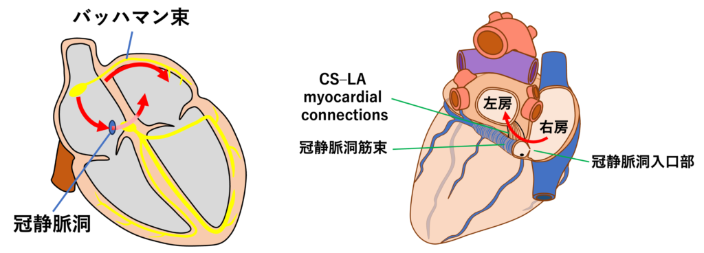 心房間ブロック(Interatrial Block：IAB)
心房間伝導は主にバッハマン束によって行われますが、右房と左房を繋ぐ伝導路はバッハマン束以外にも存在しており、その一つが冠静脈洞付近に存在しており冠静脈洞筋束を介して伝導します。冠静脈洞は右房の下方に位置しており、この伝導路を介して左房に伝わった興奮は左房上方に向かっていきます。