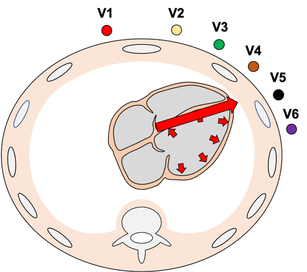 時計方向回転(clockwise rotation)
拡張型心筋症では左室が全体的に拡大します。これにより水平面では心室中隔がV6誘導方向にシフトし、移行帯が左方であるV5以降にずれやすくなります。直感的には左室が拡大すれば中隔が右室側に押しやられるように感じますが、移行帯を判断する水平面においては左方シフトが優位に働きます。