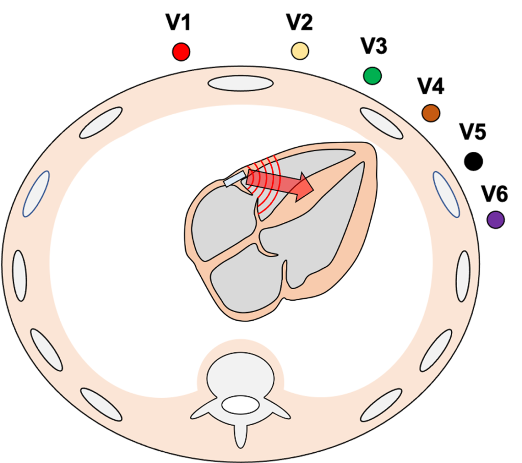 時計方向回転(clockwise rotation)
WPW症候群のB・C型では右室側の副伝導路から早期興奮が始まるため、右室が先に興奮して左室の興奮が相対的に遅れます。その結果、胸部誘導でR波の増高が遅れ、移行帯が左方(V5以降)にずれる時計方向回転のパターンをとりやすくなります。