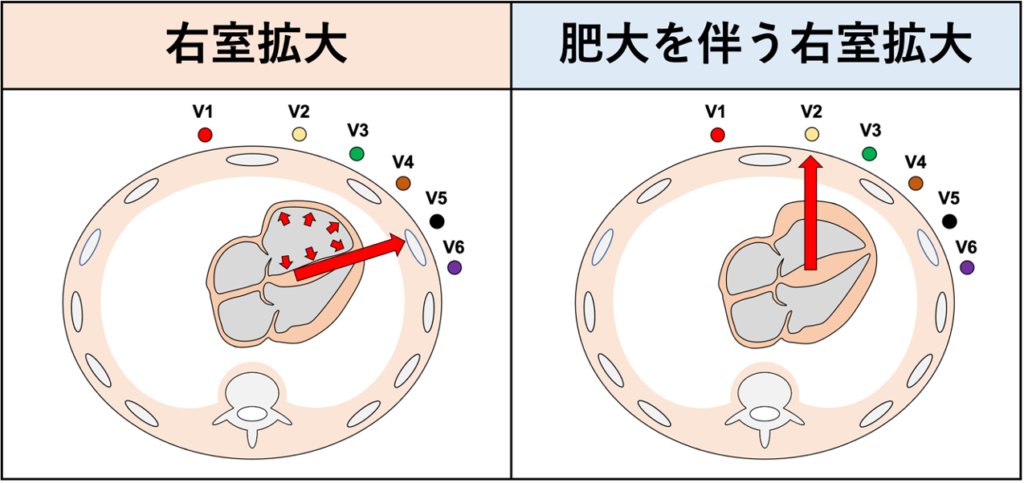 時計方向回転(clockwise rotation)
右室が拡大すると心室中隔と左室が時計方向に押しやられます。特に急性肺塞栓症などの急性の右室負荷では変化が著明になります。その結果として移行帯がV6誘導方向にずれ、時計方向回転を呈します。ただし、右室肥大を伴う場合は右室起電力の増大によってV1誘導のR波が増高し、むしろ反時計回転を示す場合もあります。