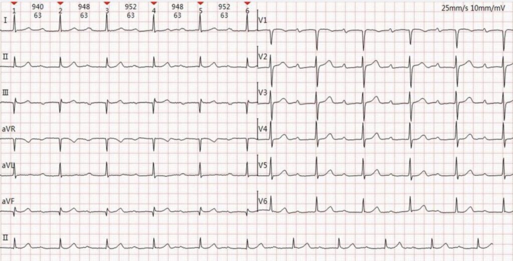 Marked First Degree AV Block