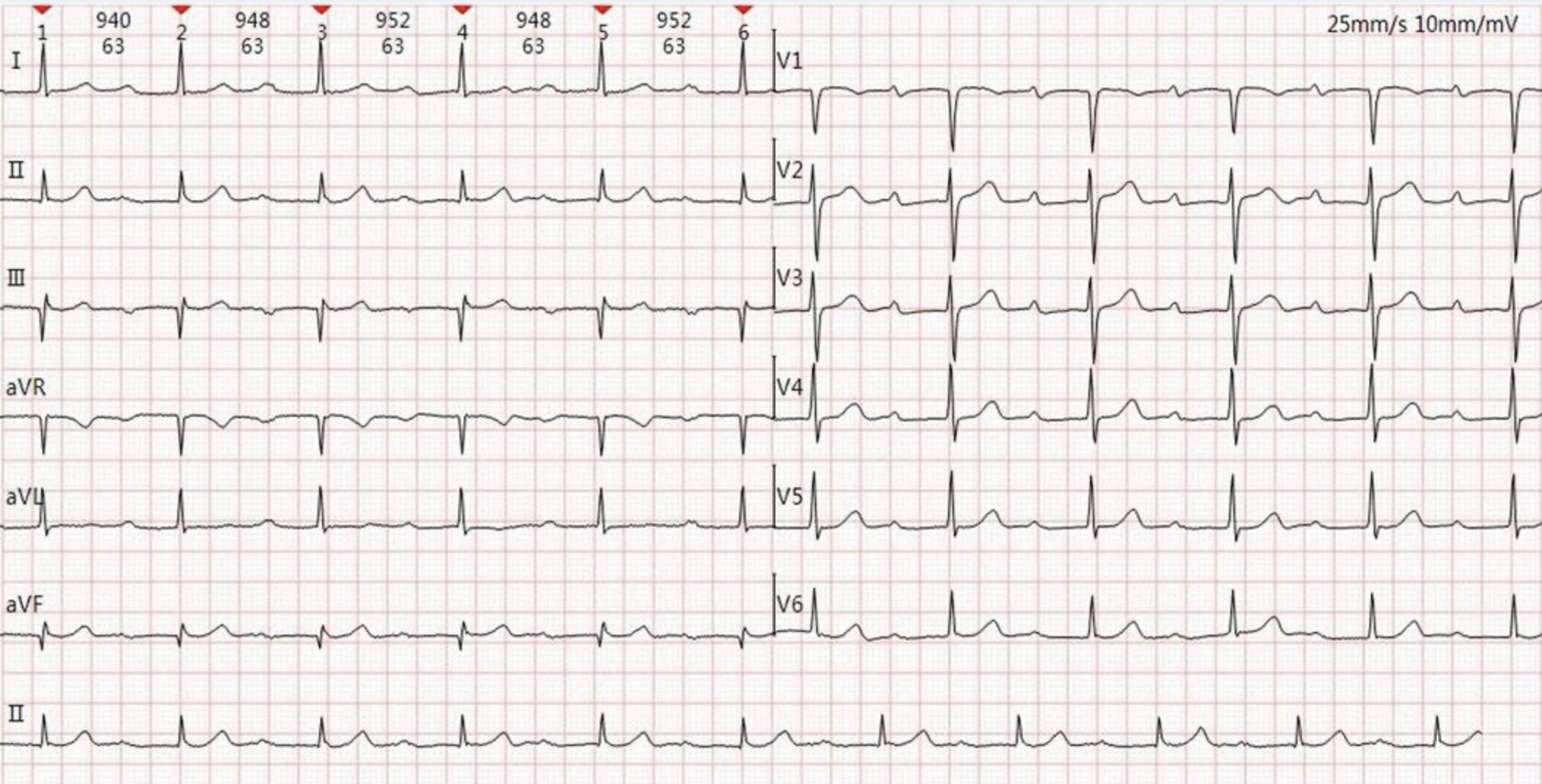 Marked First Degree AV Block